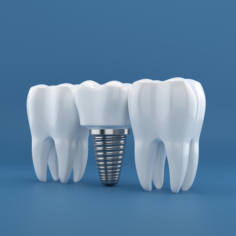 Ein Implantat zwischen zwei Zähnen