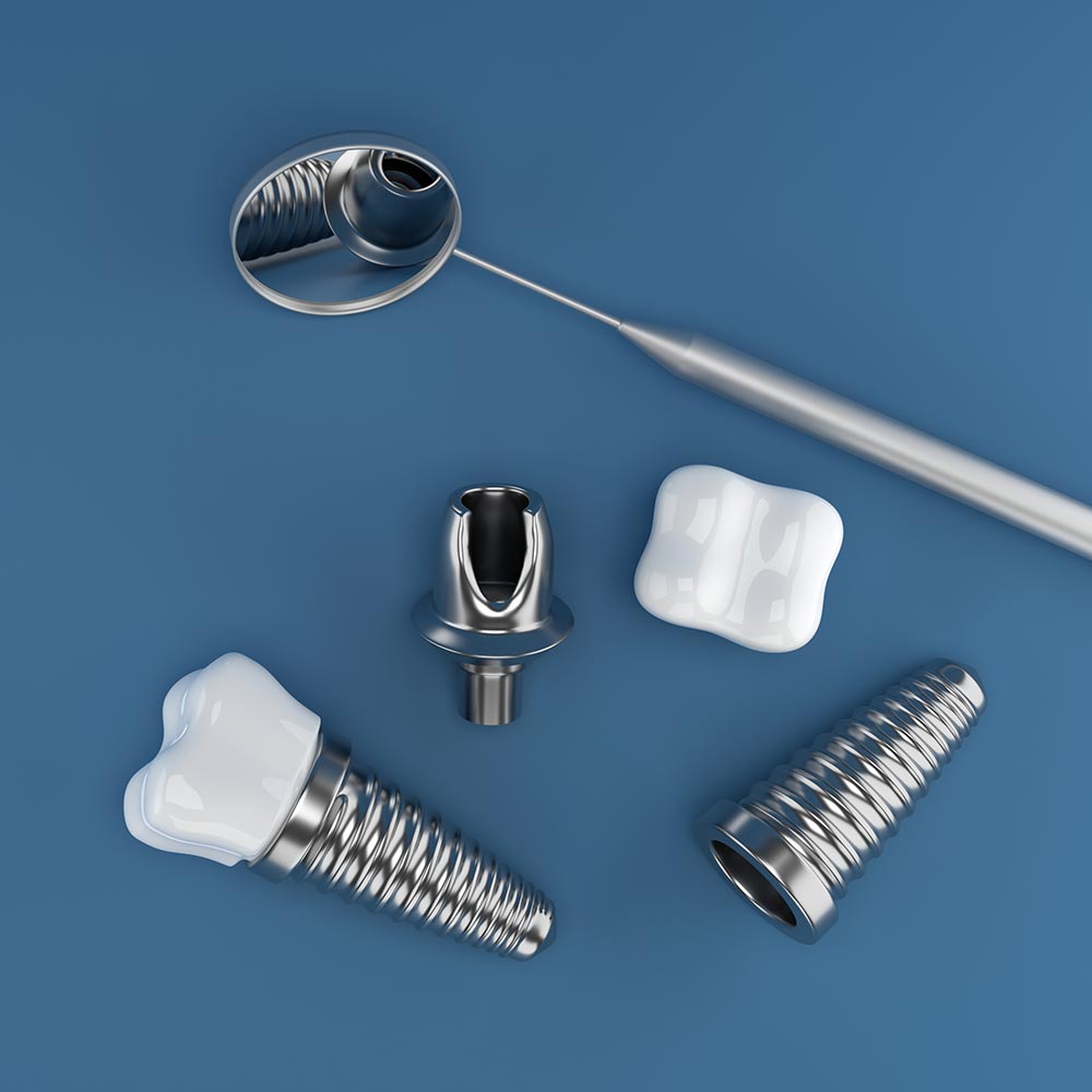 Implantate liegen mit einem Zahnarztspiegel auf blauem Untergrund